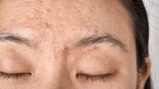 Facial skin problem, Aging problem in adult, wrinkle, acne scar, large pore and dark spot, Dehydrate skin.