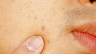 Closeup of Acne Scar 