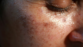 Pigmented spots on the face. Pigmentation on cheeks