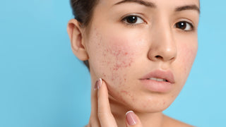 Teen Girl with Acne Problem on Light Blue Background