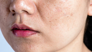 Woman with problematic skin and acne scars. Problem skincare and health concept. Wrinkles melasma Dark spots freckles dry skin and pigmentation on face