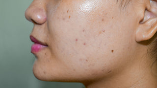 dark spots and acne scars on skin
